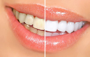 Whiten Your Teeth Without Going to the Dentist