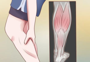 Can You Get Rid Of Leg Cramps During Sleep?