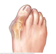 Is there a home remedy for bunion’s?
